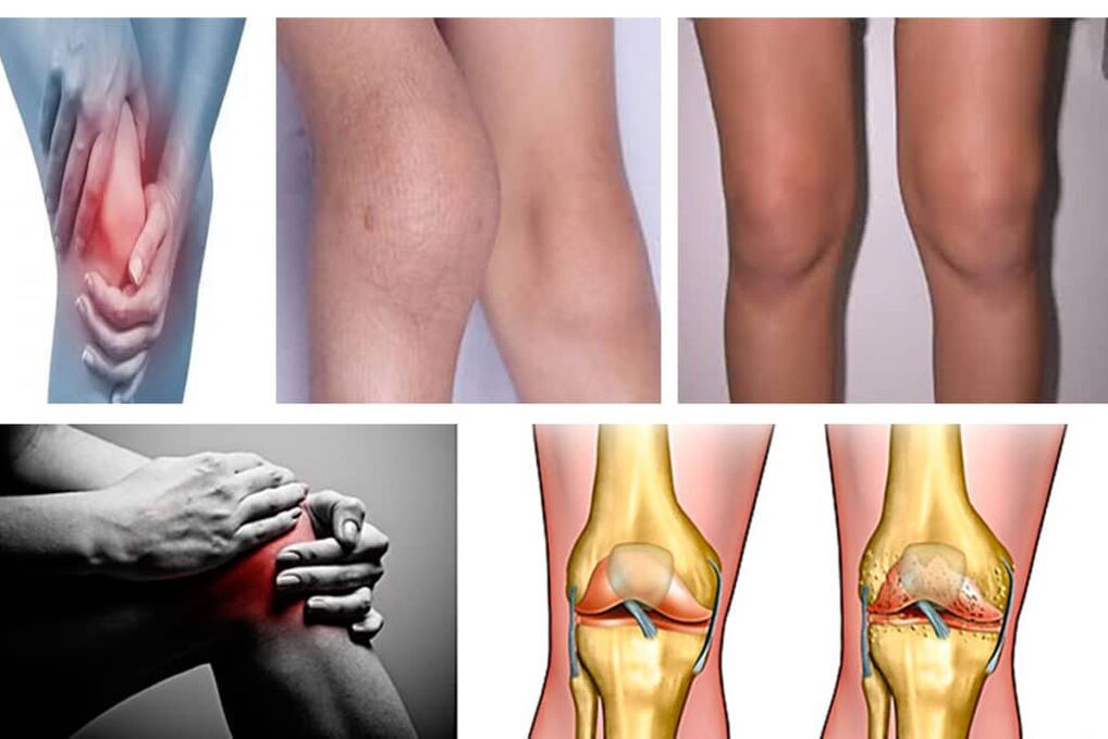 Symptoms of arthrosis of the knee